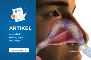 Gambar 1. Polip di lubang hidung kanan dan kiri