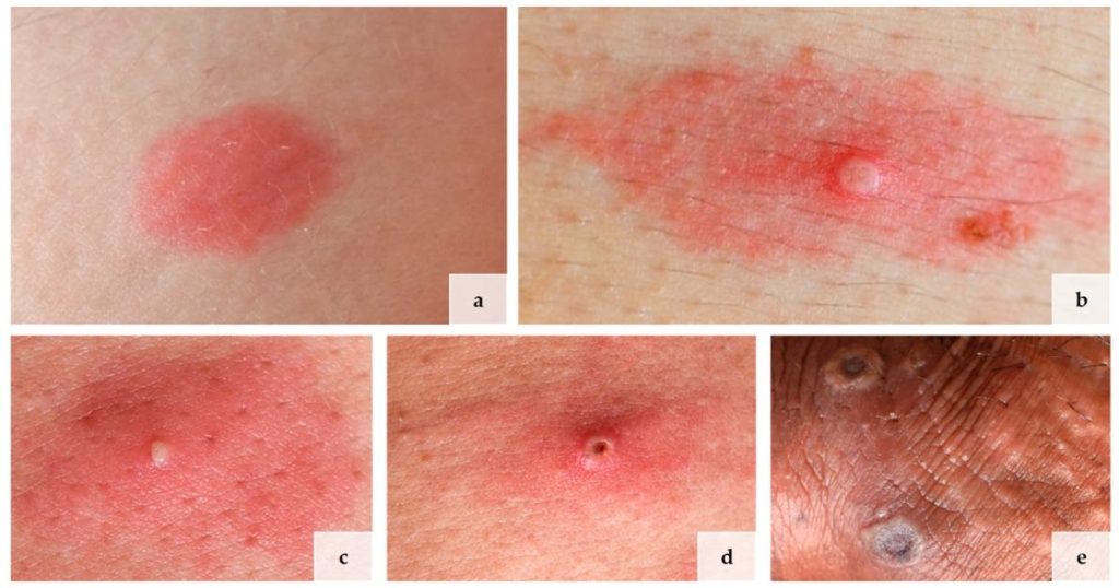 Fase progresifitas ruam kulit pada infeksi Mpox (tampak atas)
Sumber : (Schmidle et al., 2023)