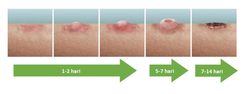 Fase progresifitas ruam kulit pada infeksi Mpox (tampak samping)

Sumber : (Titanji et al., 2022)